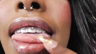 Black girl teeth brace fetish!